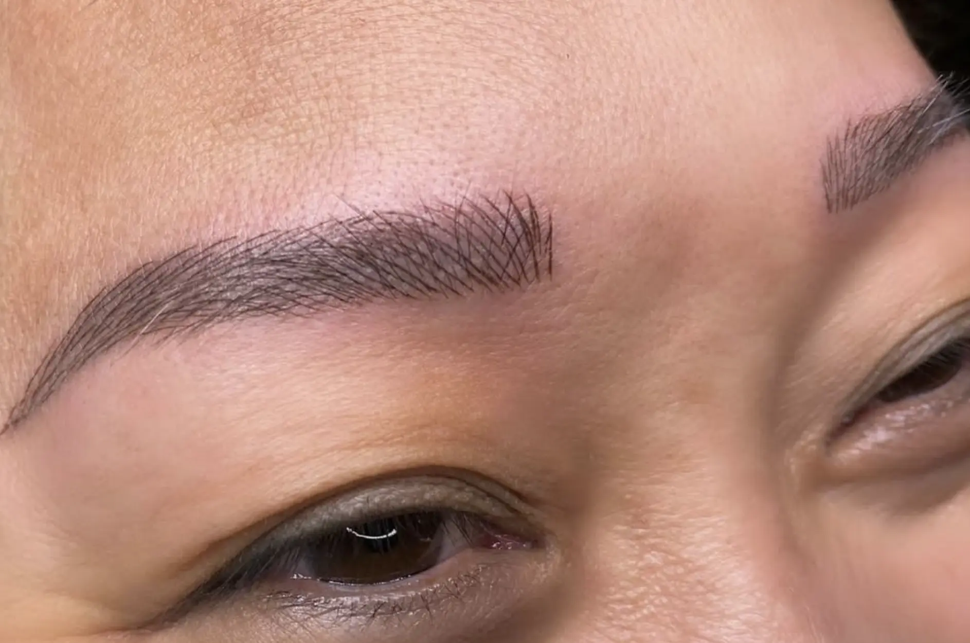 eyebrow tattoo removal Melbourne
