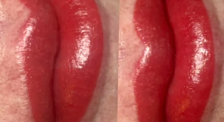 cold sores after lip blush
